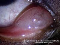 Conjunctival Cysts